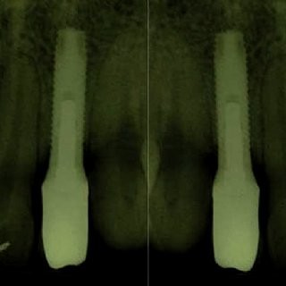 Röntgenaufnahme mit Implantat und Kronen rechts und links