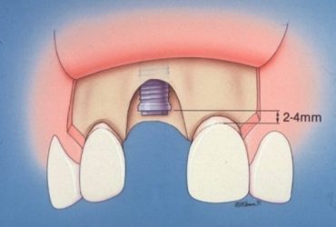 Knochendefekt nach Extraktion eines Zahnes und gleichzeitig Implantation