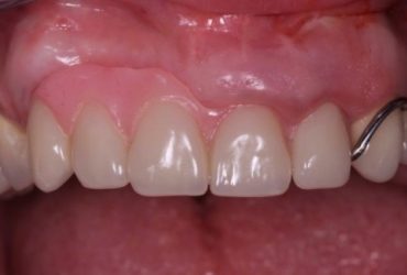 Teilprothetische Versorgung nach Zahn-, Weich- und Hartgewebs-Verlust
