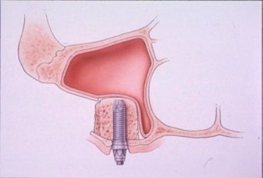 Frontalansicht eines Kieferhöhlenaufbaus (Sinuslift) mit Knochenersatzgewebe