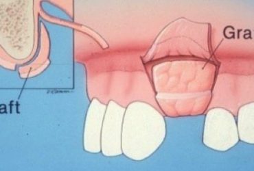 Transplantation von Zahnfleisch kann die defekt Stelle