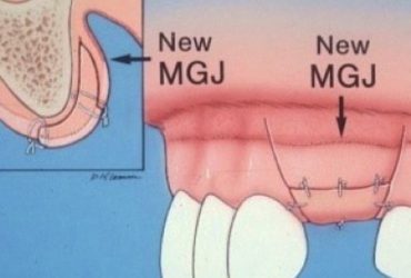 Aus dem Gaumen entnommen ist Zahnfleisch zur Defektdeckung transplantiert