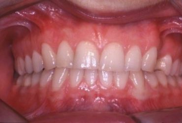Zahnfleischtransplantationen_00359