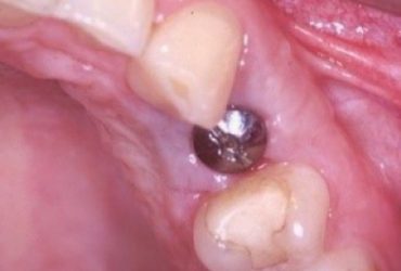 Zahnfleischtransplantationen_00363