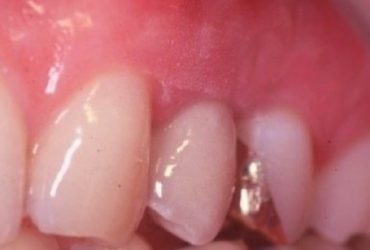 Zahnfleischtransplantationen_00364