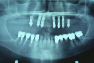 Röntgenaufnahme eingesetzte Implantate mit aufgebrachten Durchtrittspfosten