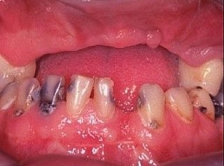 Knochen Weichgewebe zu Zahnverlust nach Autounfall, stark Karies befallenes Gebiss im Unterkiefer